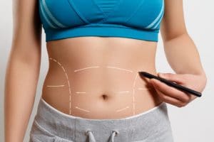 Getting Ready for Your Tummy Tuck