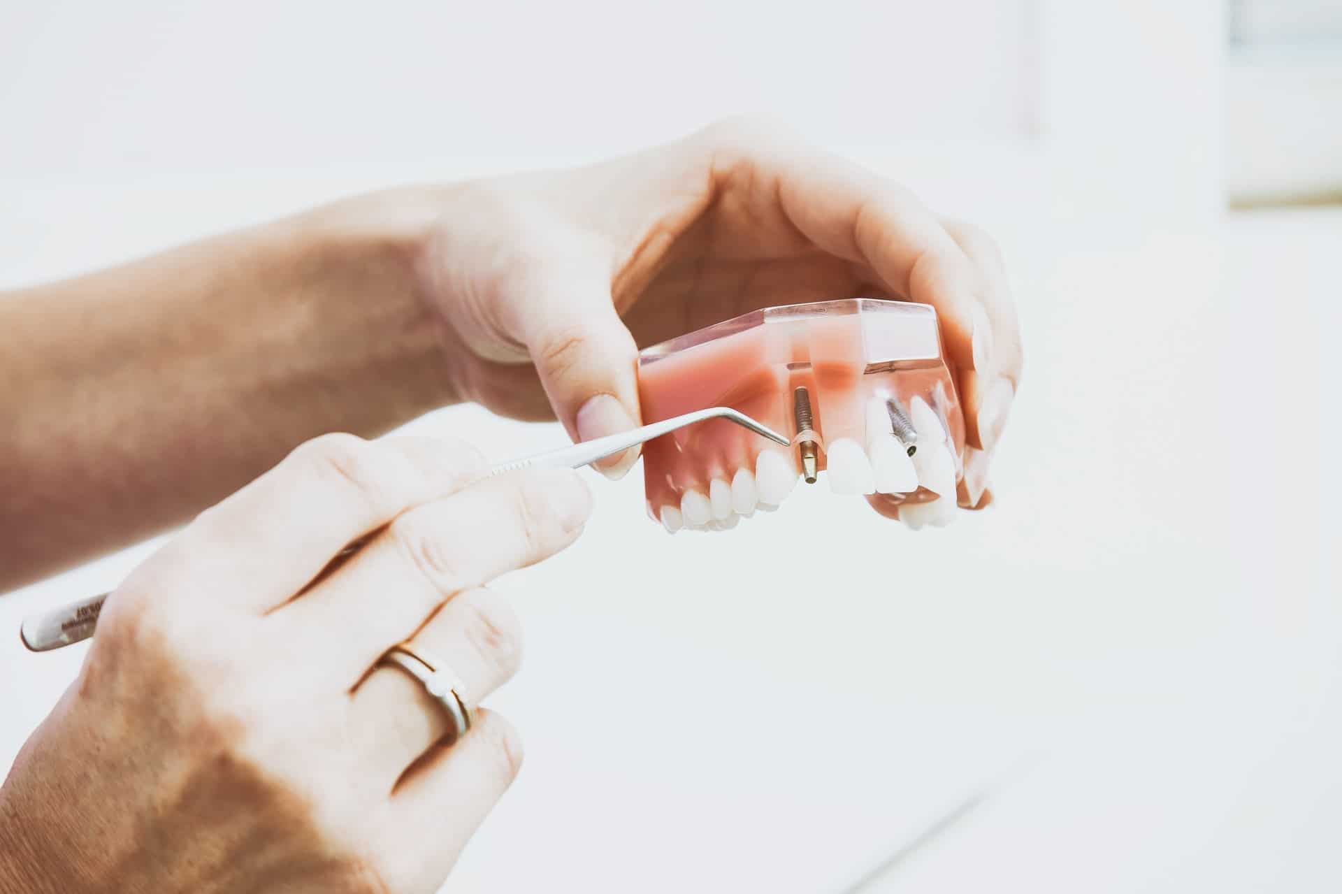 peter kasprzyk U1gvhqVQ2kQ unsplash - Four Main Types of Dental Implants According to Dentists