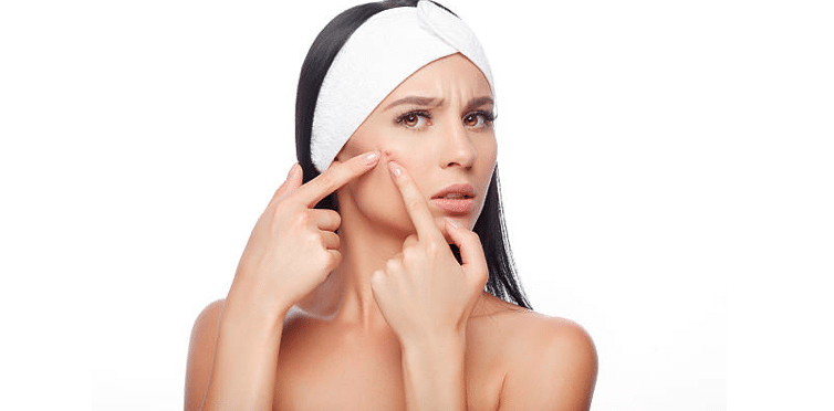 How to Cure Pimples?