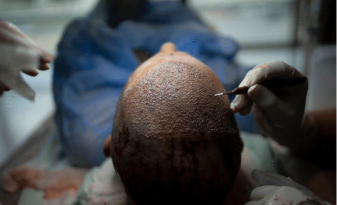 Does Hair Transplant Work?