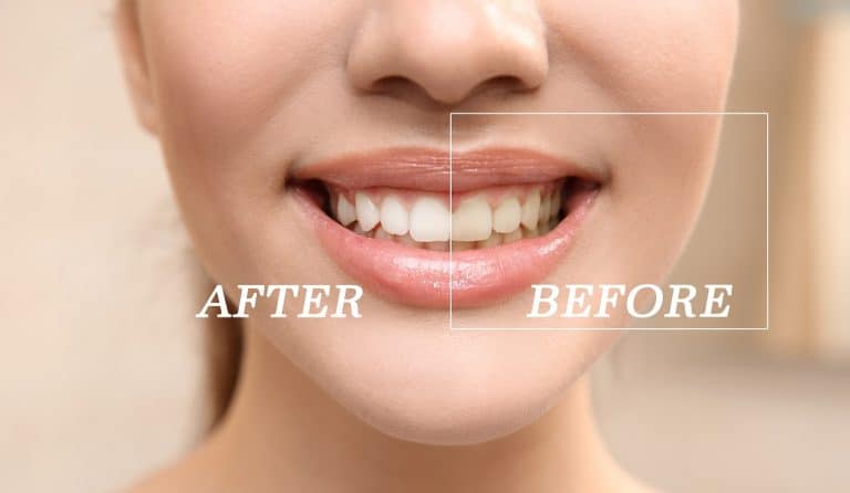 Top 10 Best Teeth Whitening Toothpaste in India 2023 According to Dentists