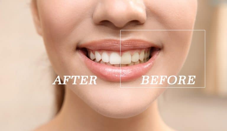 8 Things You Need To Know About Teeth Whitening