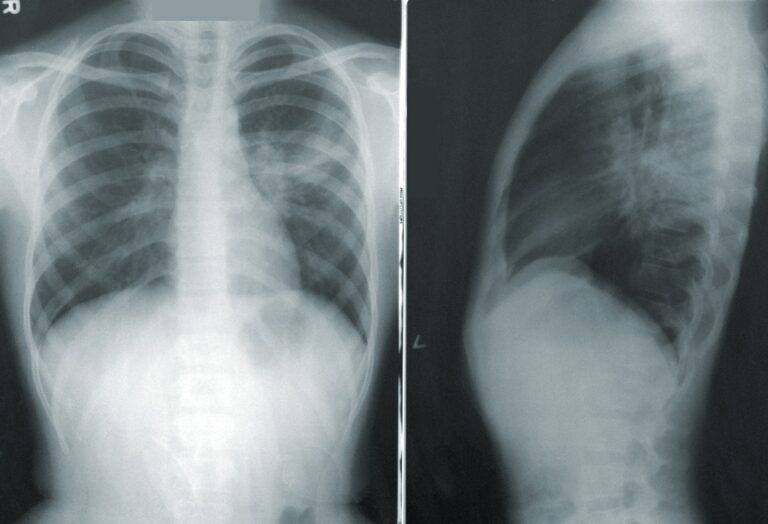 Why Might You Need a Lung Function Test After COVID-19?