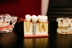 What to Do After Root Canal?