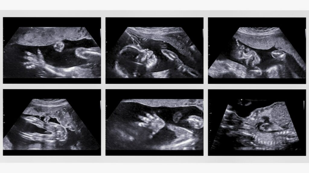 collage of medical images of ultrasound anomaly scan on a female fetus 20 weeks into the pregnancy 1296x728 body1