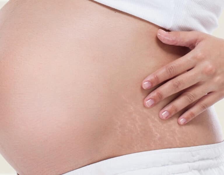 9 Home Remedies For Stretch Marks After Pregnancy