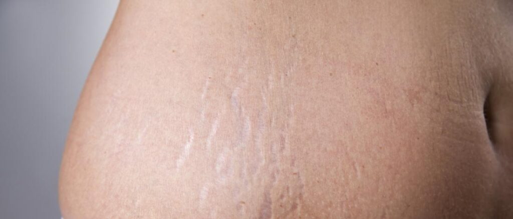 stretch marks