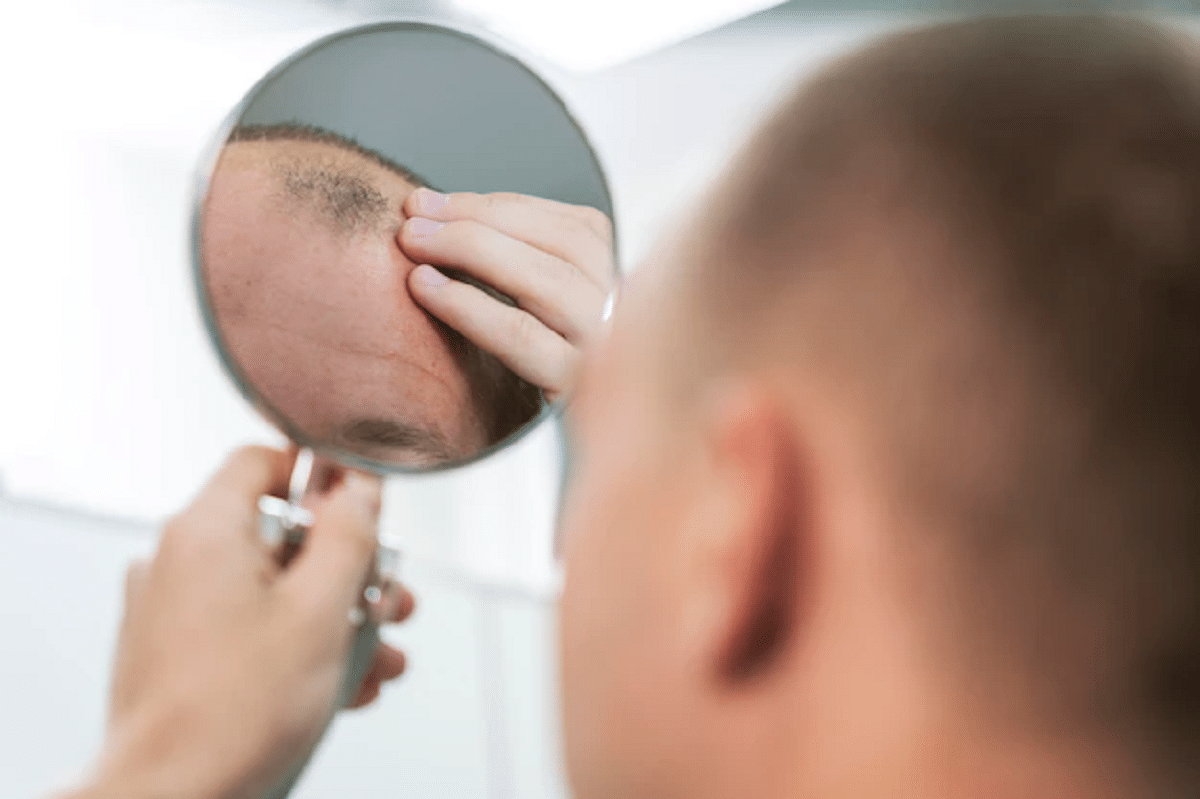 what you should know about fue hair transplants