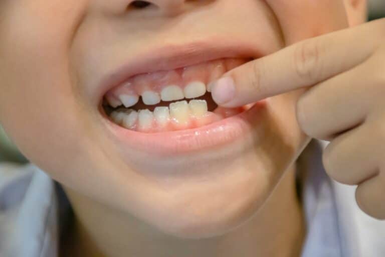 Do Baby Tooth Have Roots? And How They Should Get Pulled