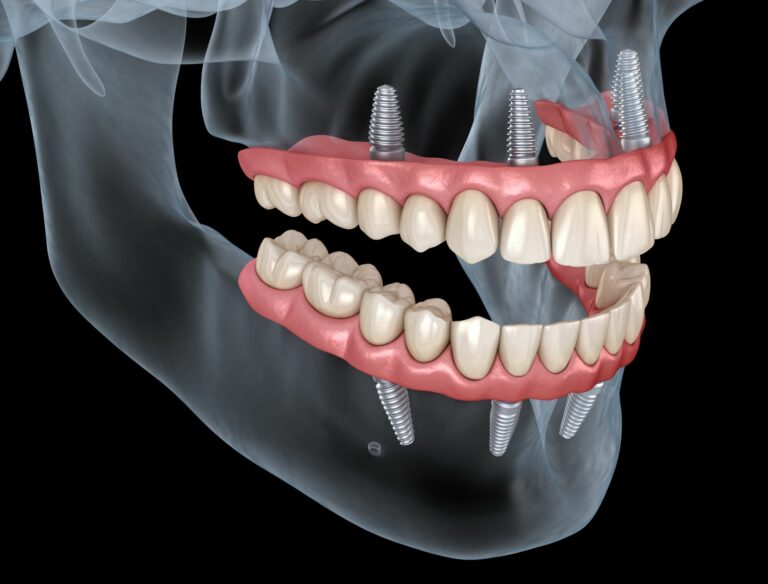 What Are All-On-4 Dental Implants? An Essential Guide