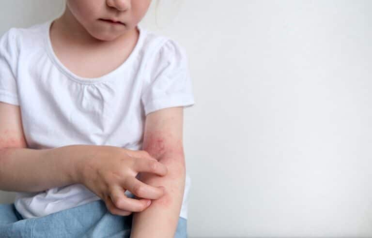 Common Skin Allergies in Kids: Causes, Symptoms and Treatments