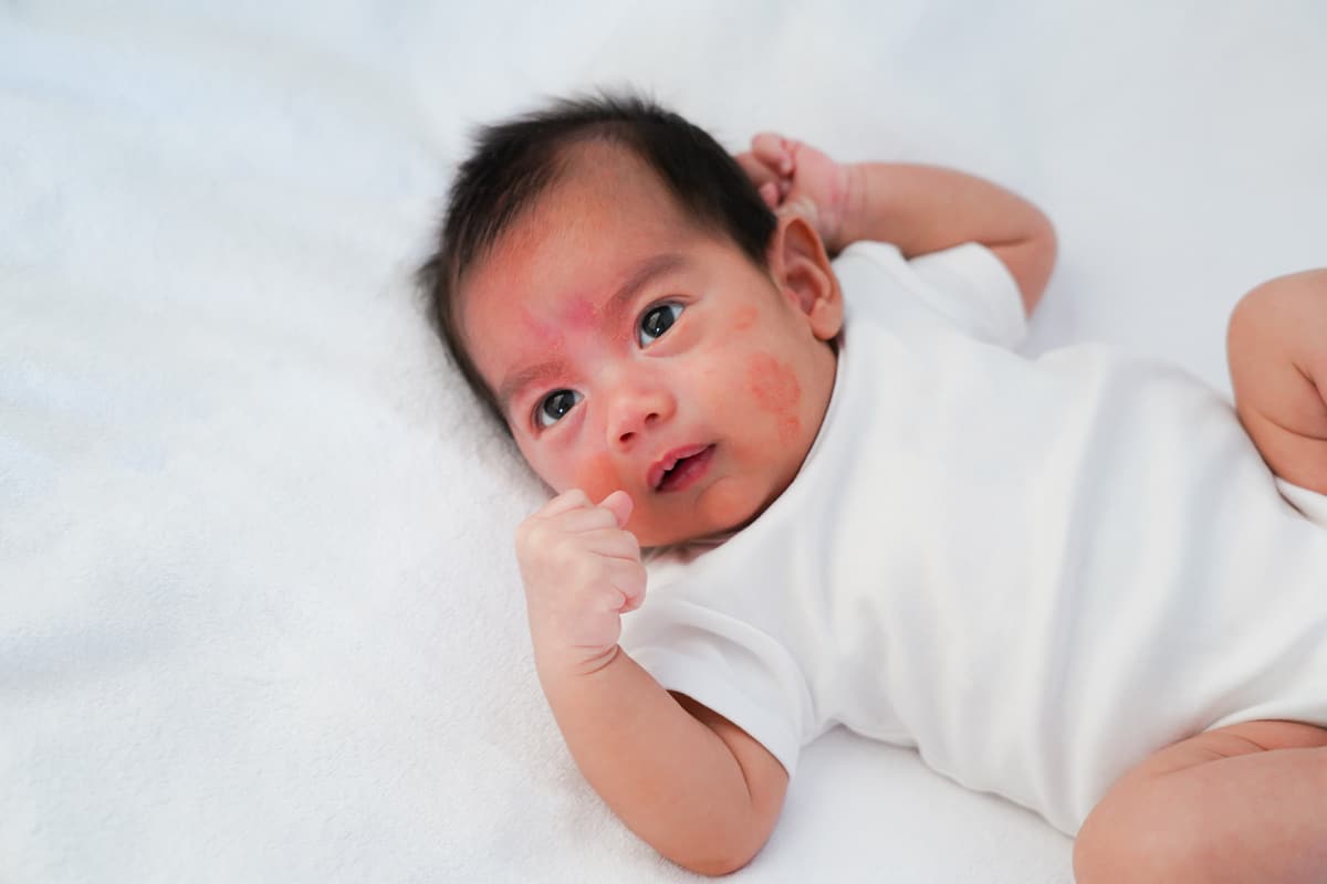 close up face of newborn baby with atopic eczema o 2022 11 04 07 02 16 utc(1)