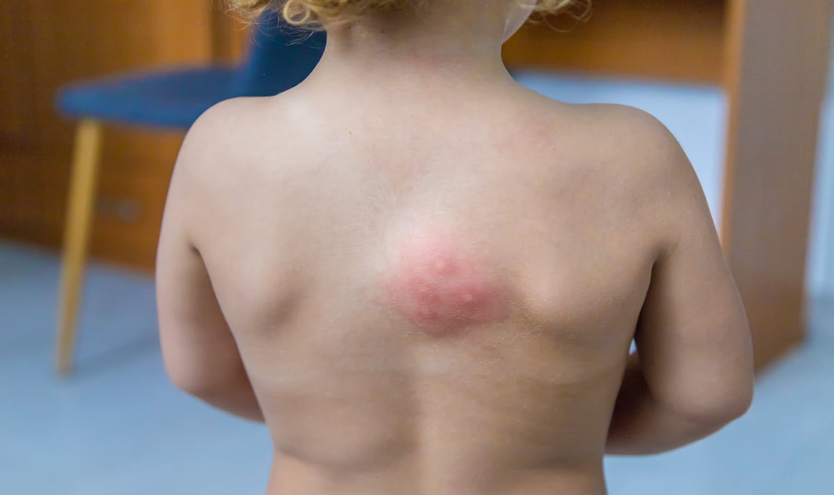 mosquito bites on a child back. selective focus.