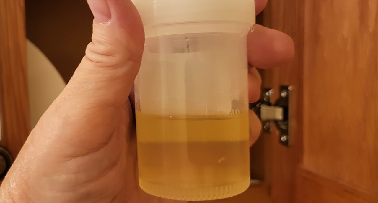 urine sample urinalysis person taking a urine sam 2022 11 08 06 10 34 utc(1)
